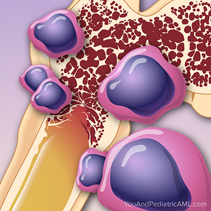 Learn about a variety of topics on pediatric AML through short animations.