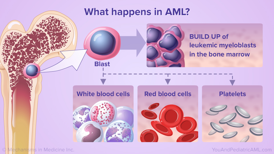 What happens in AML? 