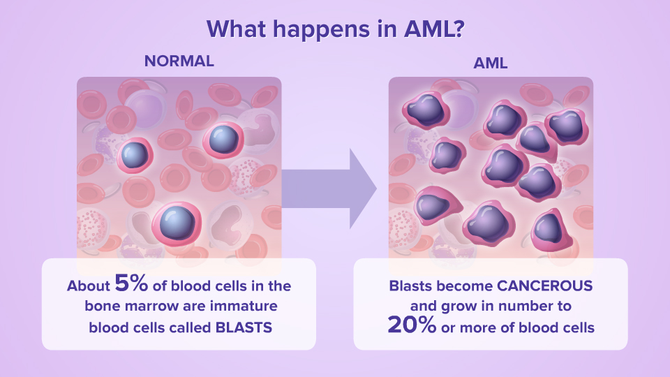 What happens in AML?