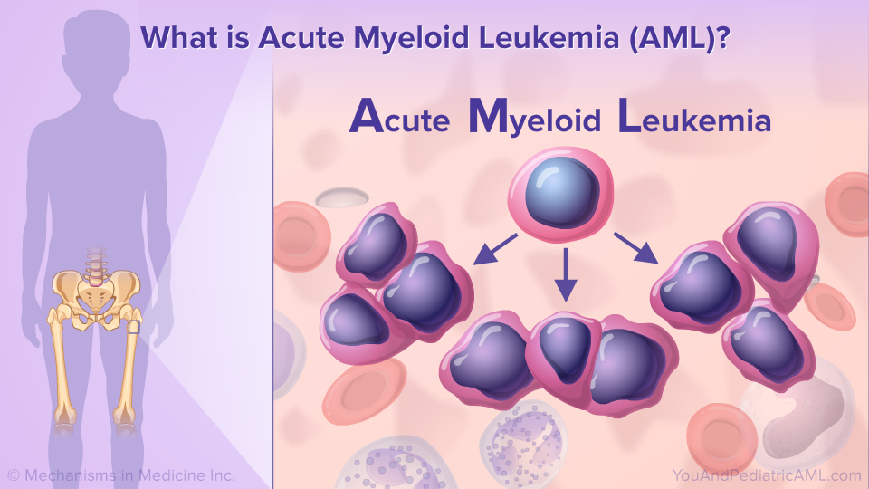 What is Acute Myeloid Leukemia (AML)?